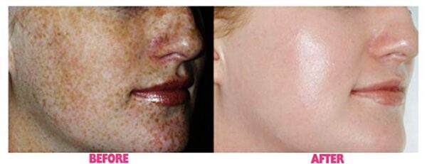 Planet Eden 70% Glycolic Acid Skin Peel with Free Fan Brush- Unbuffered Professional Grade - Image 3