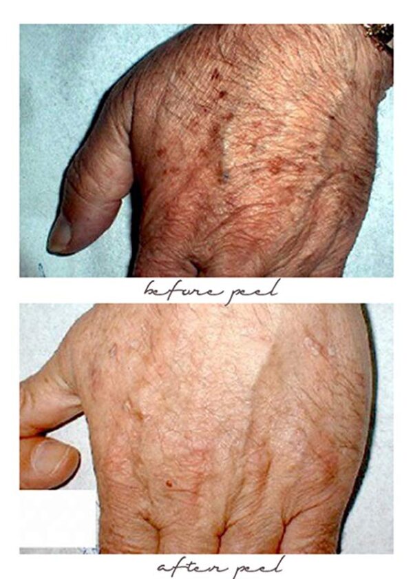 Planet Eden 70% Glycolic Acid Skin Peel with Free Fan Brush- Unbuffered Professional Grade - Image 2