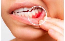 2: HOW TO EXPLAIN SENSITIVE GUMS? ( Part 2 )