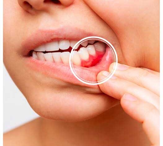 كيف تفسر العلكة الحساسة؟ (الجزء الثاني)